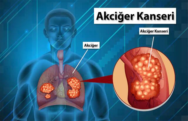 ellerde akciger kanseri belirtileri nelerdir 0 hYz8JtBL