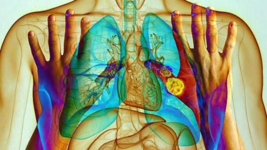 ellerde akciger kanseri belirtileri nelerdir HZiWcyLv